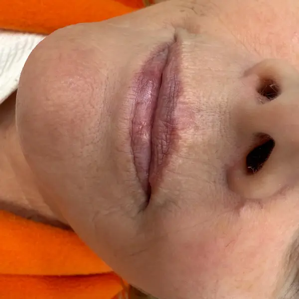 Natural lip shape before lip blush definition — pre-treatment