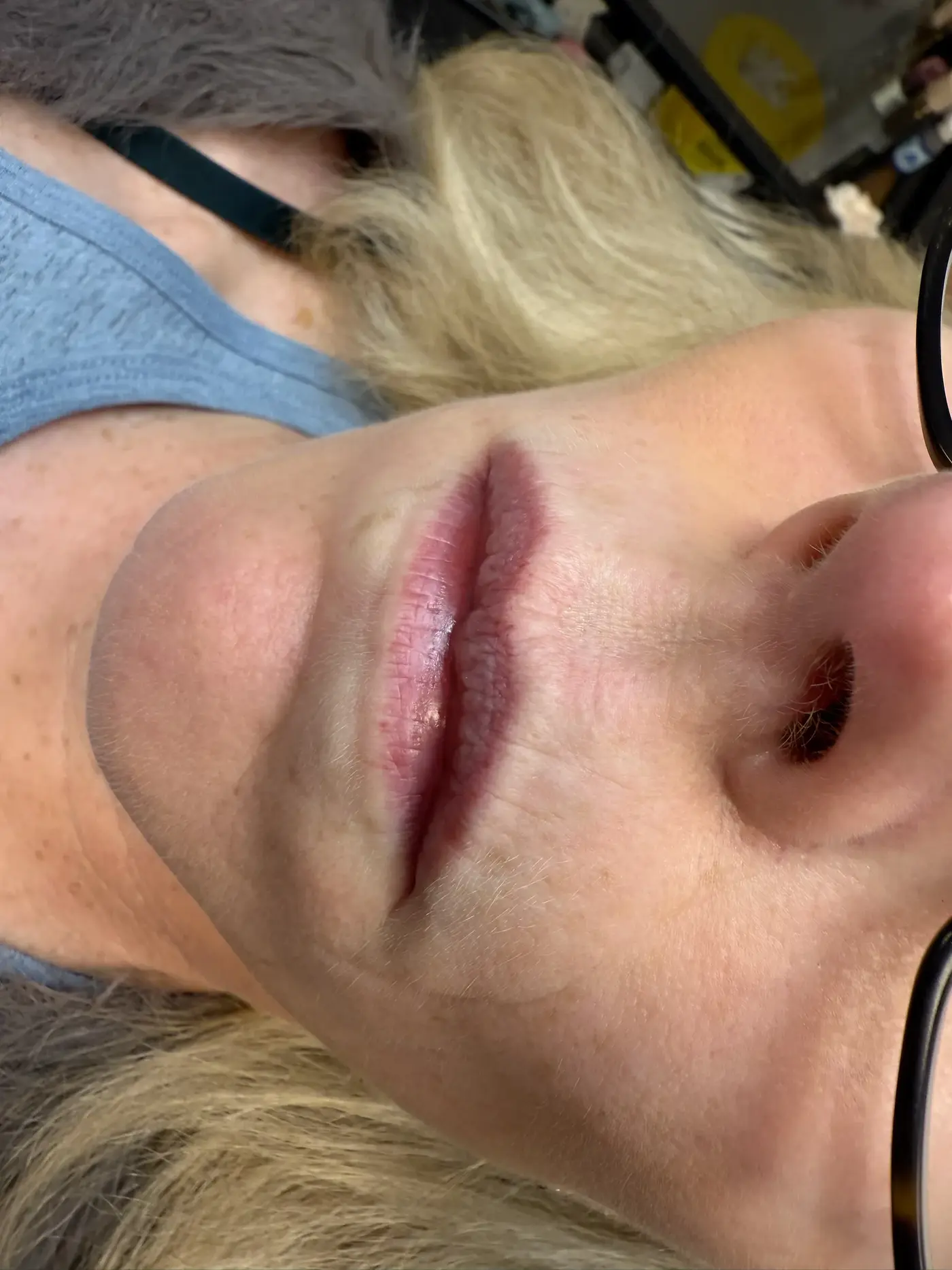 Thin lips with vertical lip lines — a real client before lip blush, considering a filler alternative