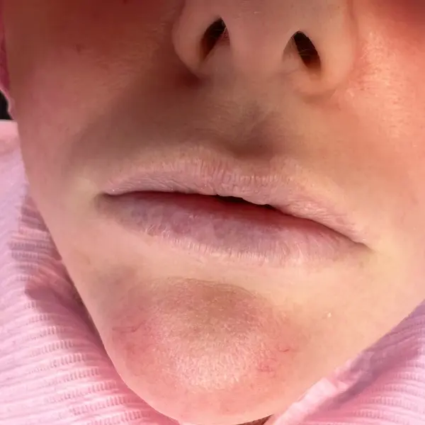 Severe pigment loss in mature lips — pre-treatment image