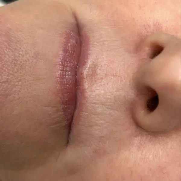 Uneven pale lip colour before lip blush restoration