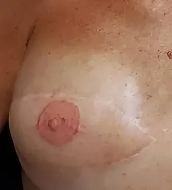 Healed areola restoration result on a real client of Lorraine — natural-looking dimensional pigment after breast cancer reconstruction, Gold Coast