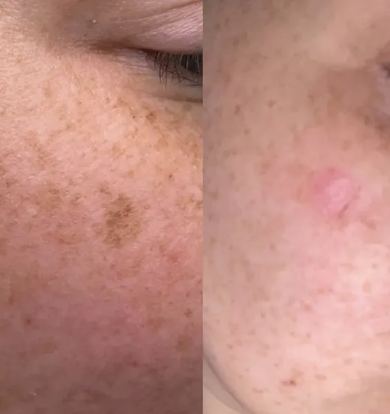 Before and after Cryotherapy facial sun spots age spots removal by Lorraine, Gold Coast