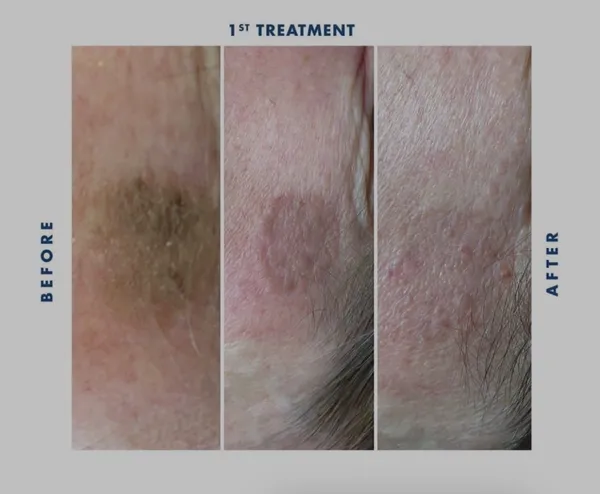 Before and after Cryotherapy pigmented lesion removal by Lorraine, Gold Coast