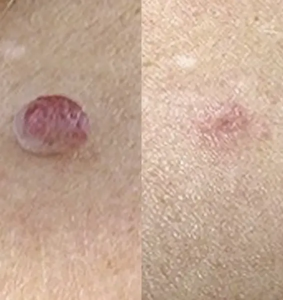 Before and after Cryotherapy raised spot removal by Lorraine, Gold Coast