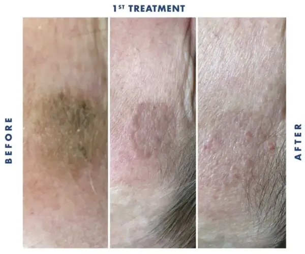 Before and after Cryotherapy seborrhoeic keratosis removal by Lorraine, Gold Coast