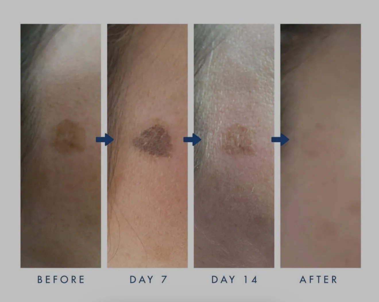 Cryotherapy lesion removal healing stages — before, day 7, day 14 and after, showing a pigmented age spot darkening then shedding to clearer skin, by Lorraine Gold Coast