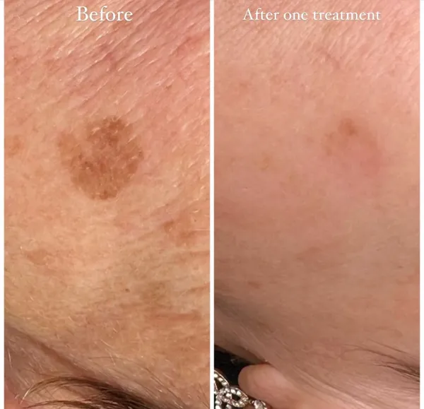 Before and after Cryotherapy age spot removal one treatment by Lorraine, Gold Coast