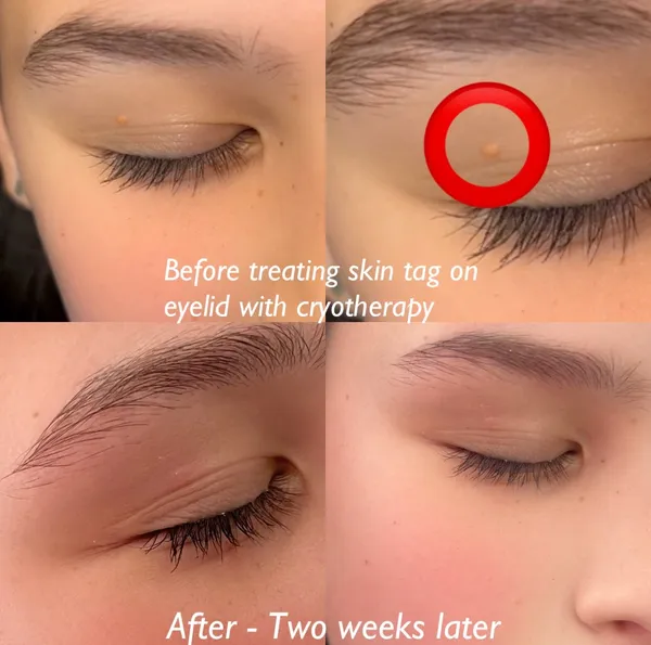 Before and after Cryotherapy skin tag eyelid removal by Lorraine, Gold Coast
