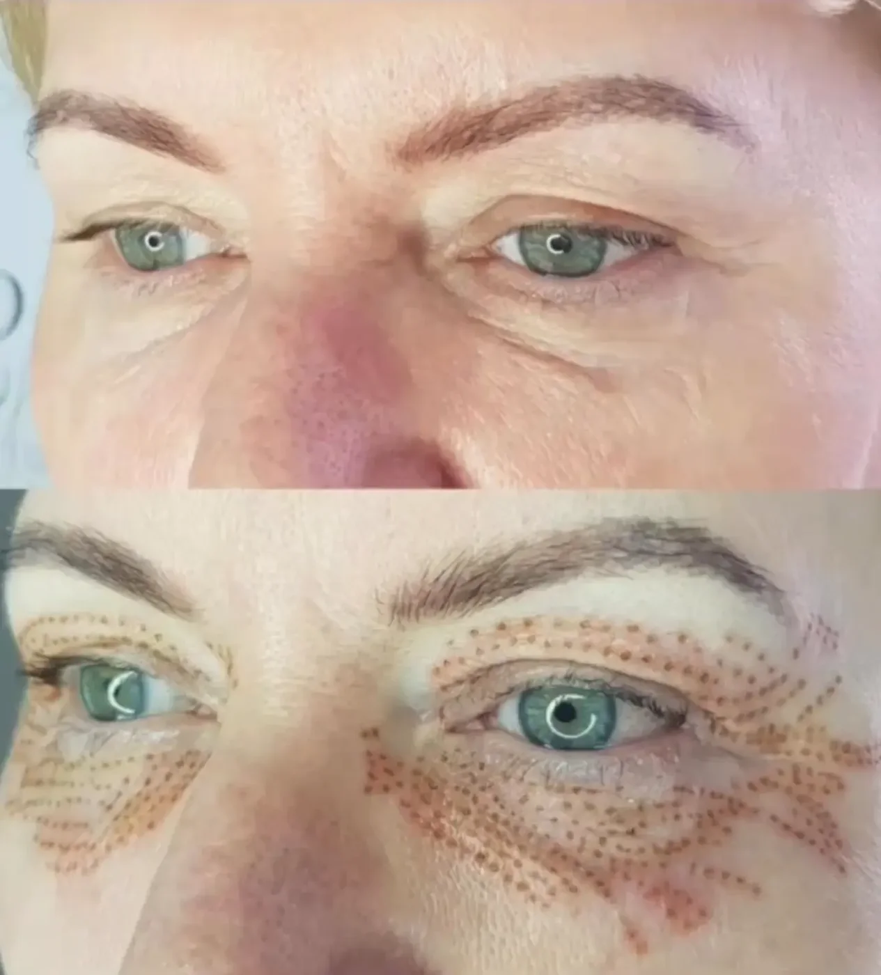 Plasma fibroblast eye treatment in progress by Lorraine — the plasma pen mapping grid of treatment points around the eye before tightening, Gold Coast
