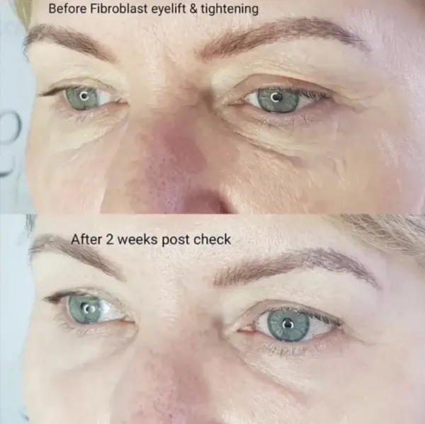 Before and after Plasma fibroblast eye lift tightening by Lorraine, Gold Coast