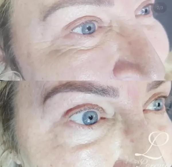 Before and after Plasma fibroblast hooded eye lift by Lorraine, Gold Coast