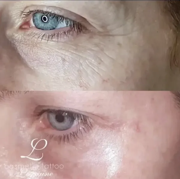 Before and after Plasma fibroblast under eye skin tightening crepey skin by Lorraine, Gold Coast