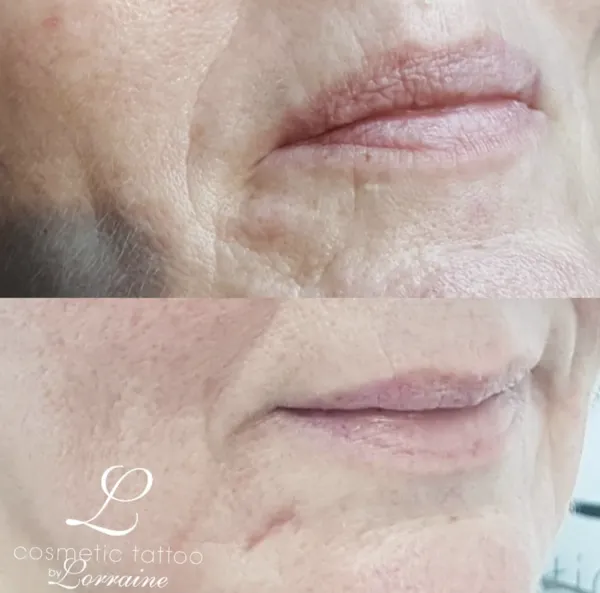 Before and after Plasma fibroblast skin tightening around mouth perioral lines by Lorraine, Gold Coast