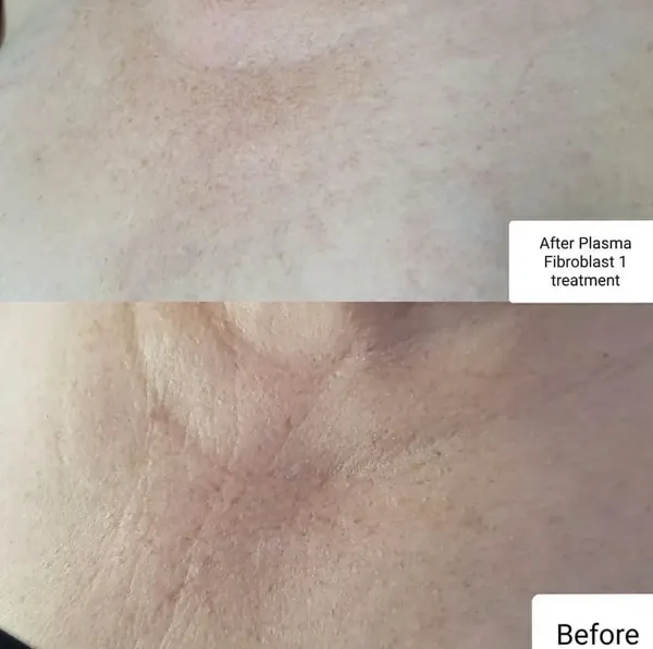 Before and after Plasma fibroblast skin tightening décolletage chest one treatment by Lorraine, Gold Coast