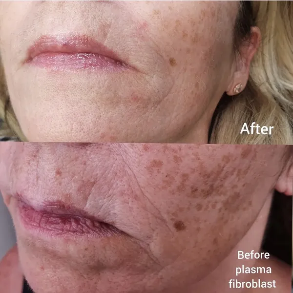Before and after Plasma fibroblast skin tightening jawline lower face by Lorraine, Gold Coast